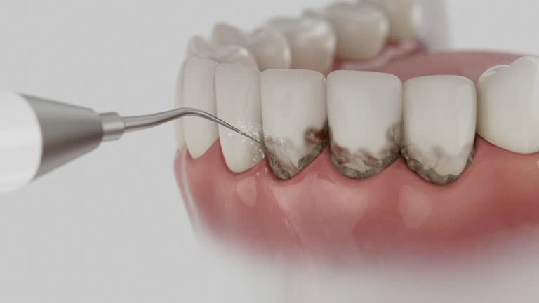 Trusted Wisdom Tooth Removal service in Columbus AFB, MS - Dentist Open Now